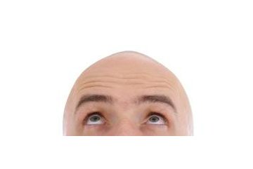 Dědičné vypadávání vlasů - Androgenní alopecie Dědičné vypadávání vlasů - Androgenní alopecie